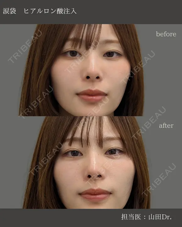 【涙袋】ヒアルロン酸注入 before画像 メイン用