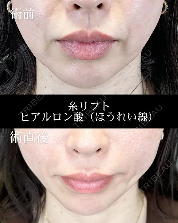 糸リフト/ヒアルロン酸注入（ほうれい線） after画像 メイン用