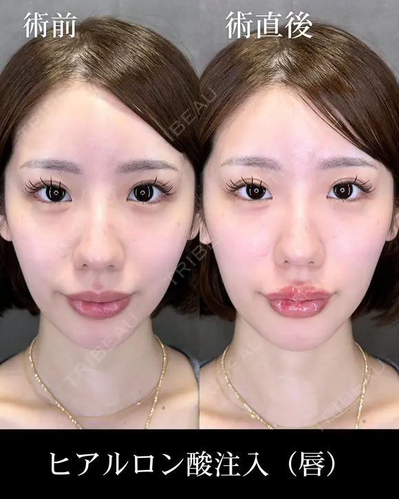 ヒアルロン酸注入（唇） before画像 メイン用