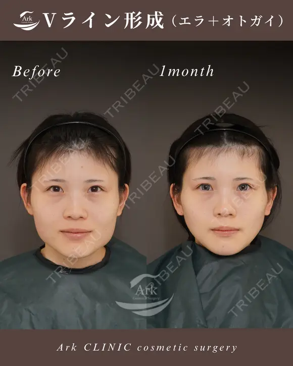Vライン形成＋外板除去＋咬筋切除 before画像 メイン用