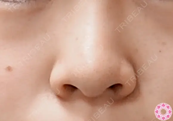 小鼻縮小　鼻翼（切開） before画像 メイン用