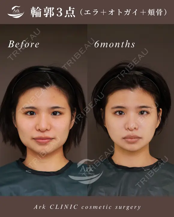 輪郭3点＋外板除去 before画像 メイン用