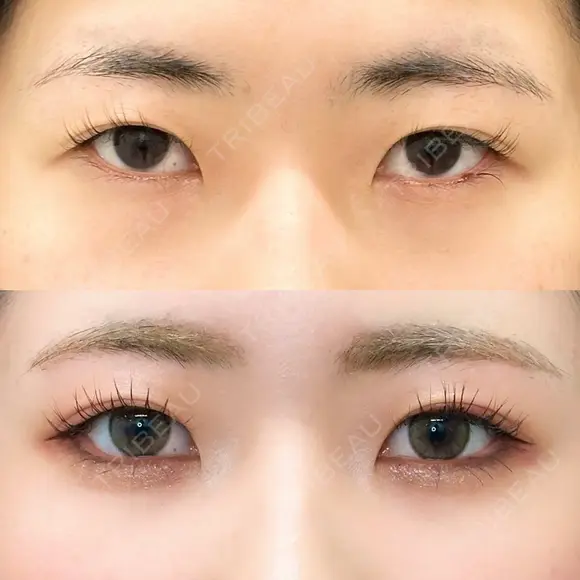 白目拡大術 after画像 メイン用