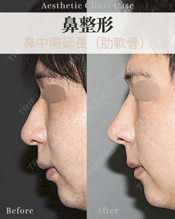鼻中隔延長　肋軟骨使用 after画像 メイン用