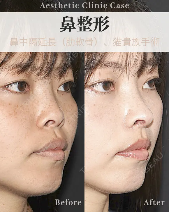 鼻中隔延長　肋軟骨使用 after画像 メイン用