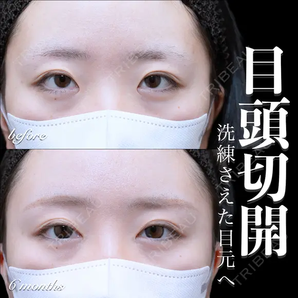 目頭切開 180日後 メイン用