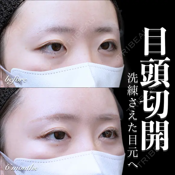 目頭切開 180日後 メイン用