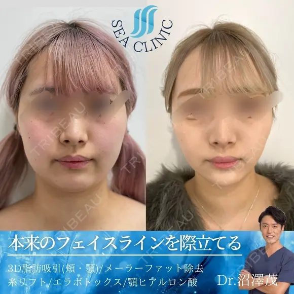 3D脂肪吸引(頬・顎)/ 糸リフト /メーラーファット除去/ あごヒアルロン酸/エラボトックス before画像 メイン用