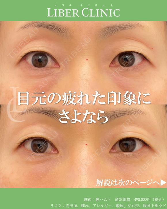 目元の疲れた印象にさよなら before画像 メイン用