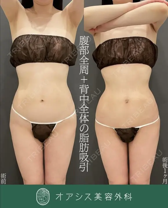 🌴コンプリート脂肪吸引【腹部フル+背中全体】背中と同時で上半身がすっきりと変化/シリンジ法 before画像 メイン用