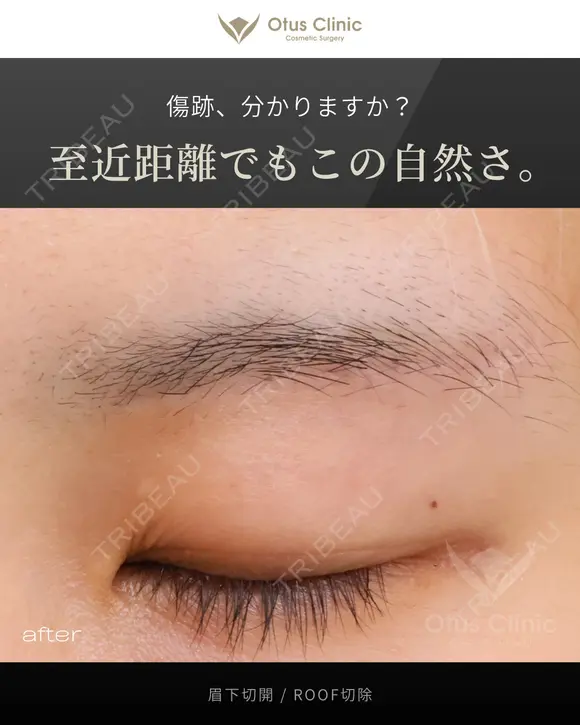 眉下切開 / ROOF切除 180日後 メイン用
