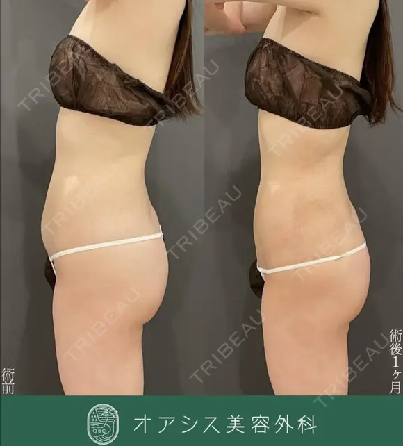 【背中全体】と【腹部フル】コンプリート脂肪吸引複合症例/シリンジ法/形成外科専門医がご対応 after画像 メイン用