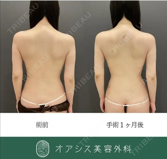 【背中全体】+【腹部フル】コンプリート脂肪吸引🌴お背中とのセット治療でスッキリ感が大きく✨ before画像 メイン用