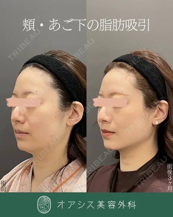 シリンジ法で細やかに吸引🌴コンプリート脂肪吸引【頬・顎下】形成外科専門医がご対応 before画像 メイン用