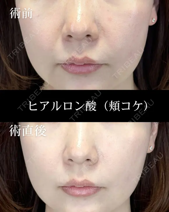ヒアルロン酸注入（頬） after画像 メイン用