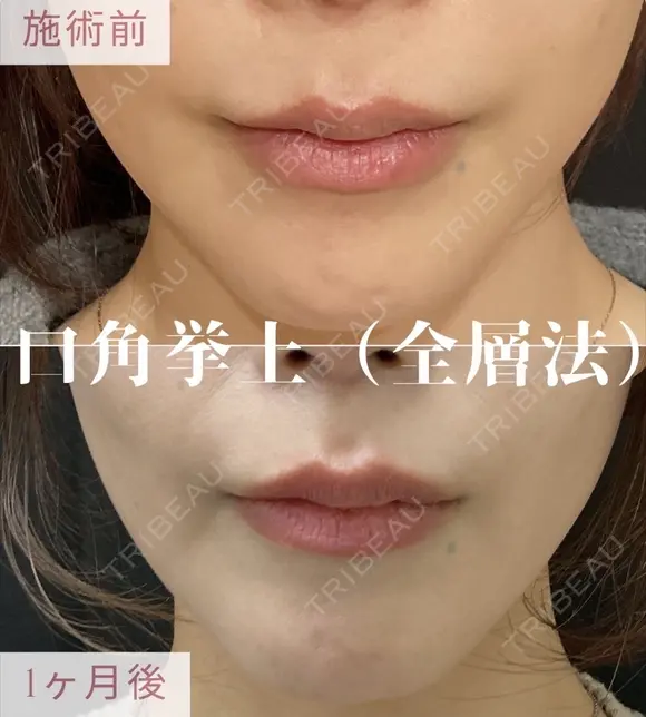口角挙上（全層法） before画像 メイン用