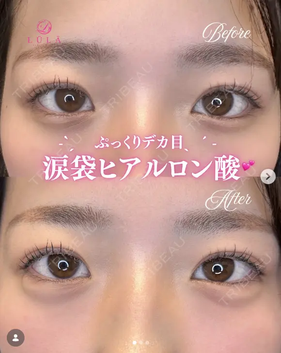 涙袋ヒアルロン酸 after画像 メイン用