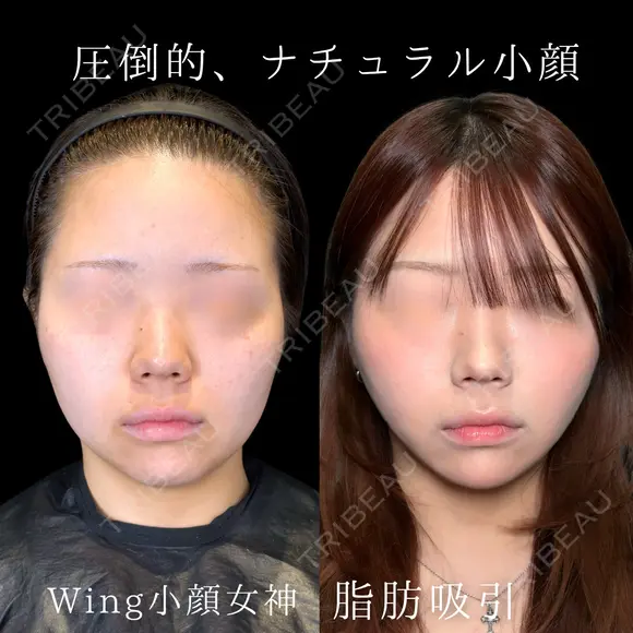 Wing小顔女神脂肪吸引 30日後 メイン用