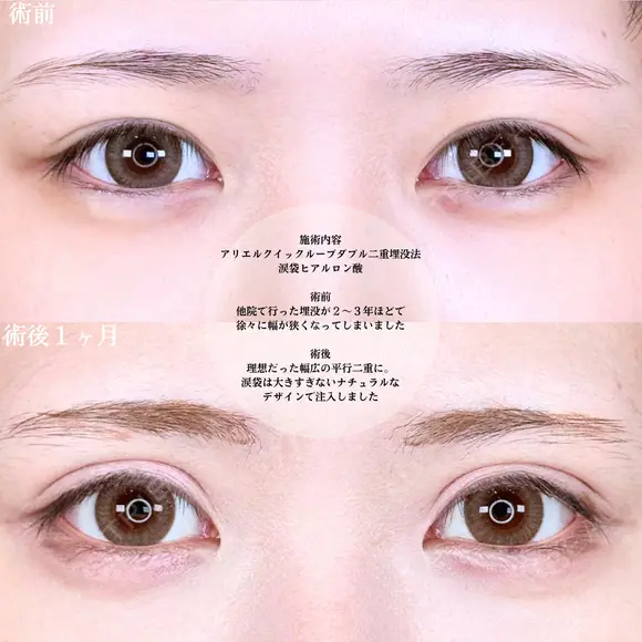 アリエルクイックループダブル二重埋没法/涙袋ヒアルロン酸 before画像 メイン用