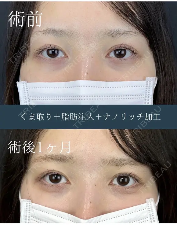 裏下スタンダードプラス脂肪注入+ナノリッチ　 after画像 メイン用