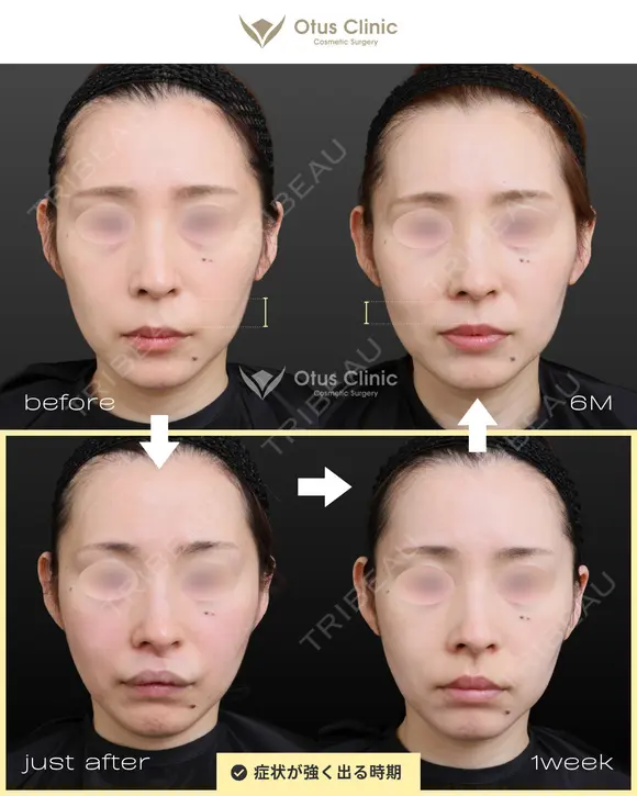 裏側人中短縮 before画像 メイン用