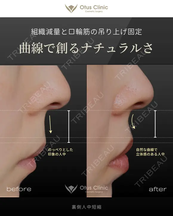 裏側人中短縮 before画像 メイン用