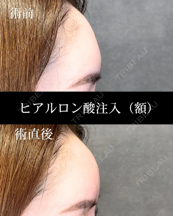 ヒアルロン酸注入（額） after画像 メイン用