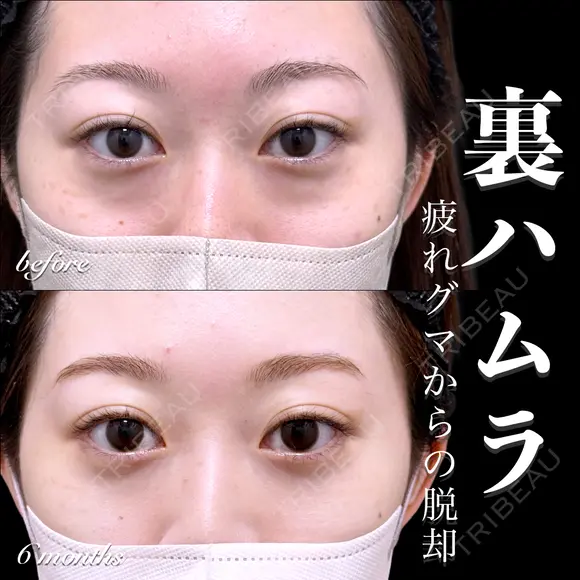 裏ハムラ 180日後 メイン用