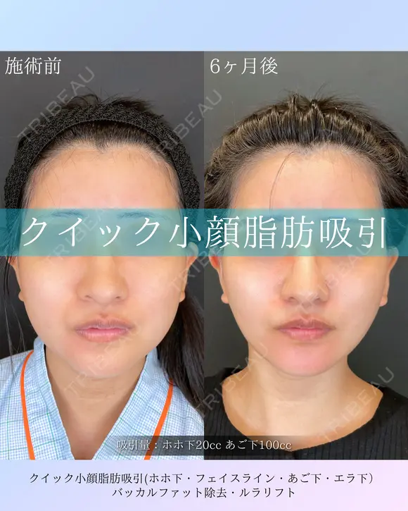 クイック小顔脂肪吸引・バッカルファット除去・ルラリフト after画像 メイン用