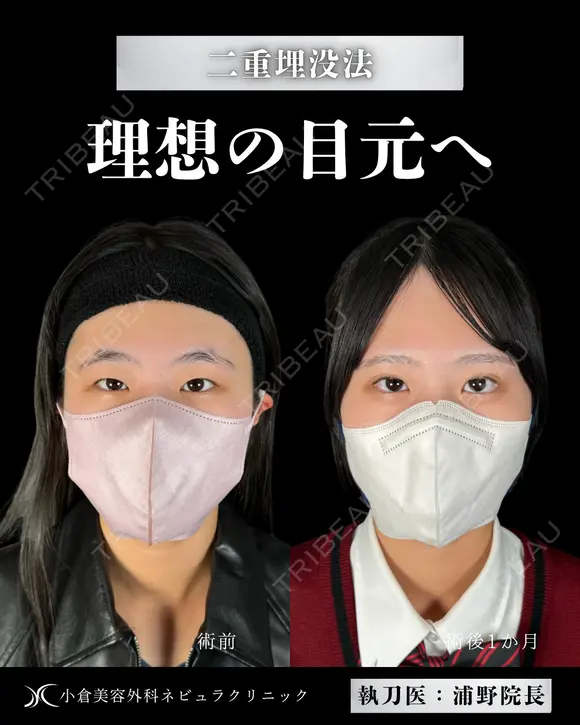 Dr浦野執刀🎀二重埋没法 before画像 メイン用