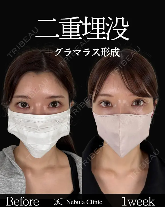 Dr岩切🎀二重埋没🎀 30日後 メイン用