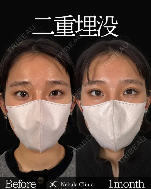 Dr岩切🎀二重埋没🎀 30日後 メイン用