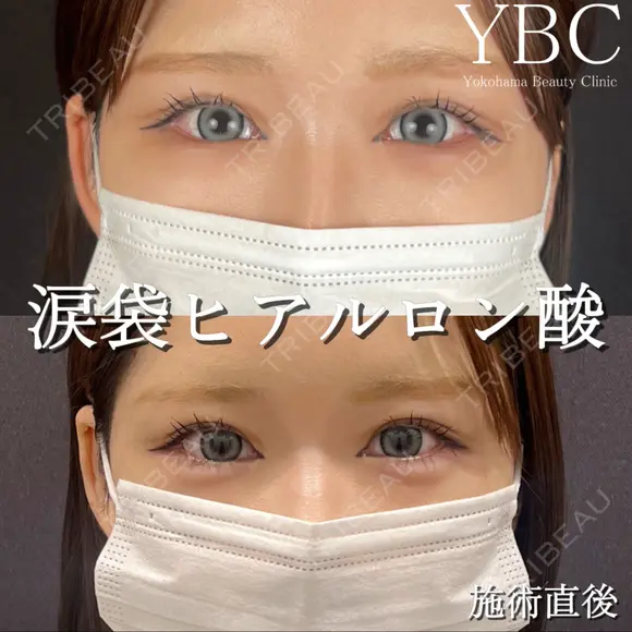 【🧸涙袋ヒアルロン酸🧸】 before画像 メイン用