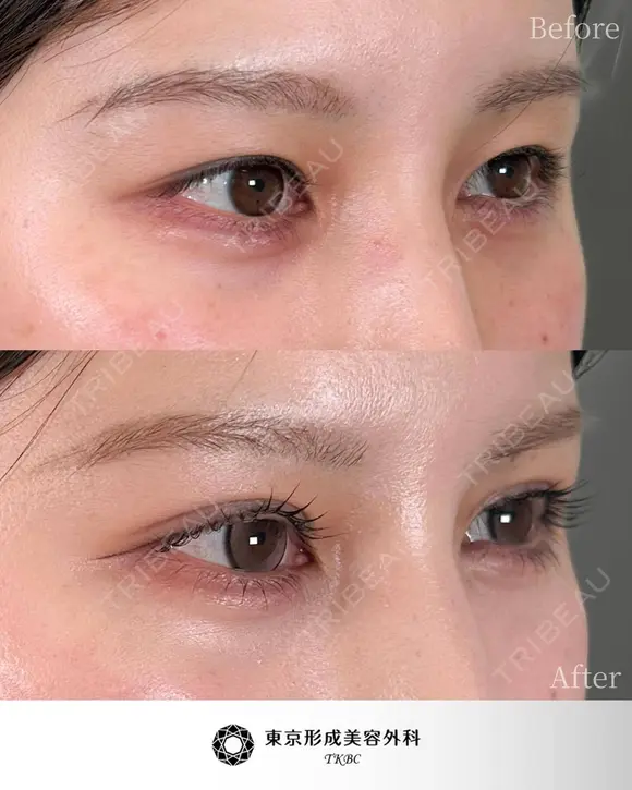 二重埋没法 before画像 メイン用