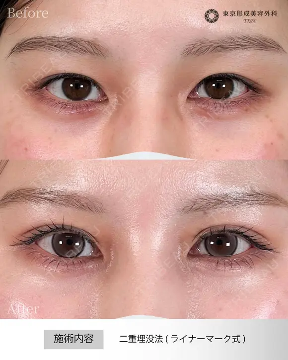二重埋没法 before画像 メイン用