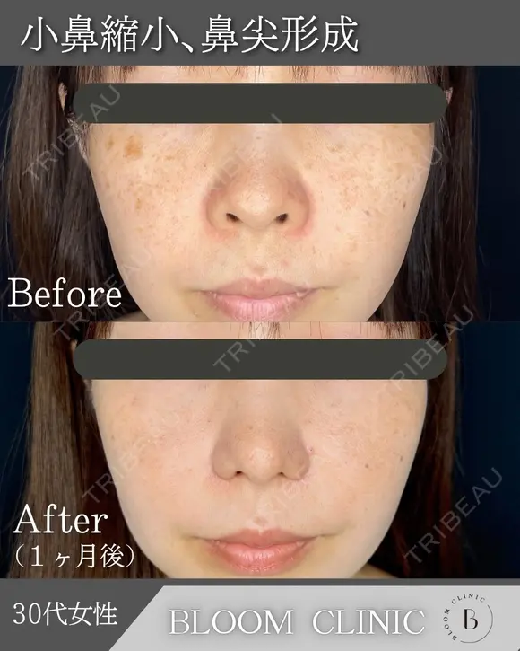 鼻尖形成・小鼻縮小☺️🌼✨ after画像 メイン用