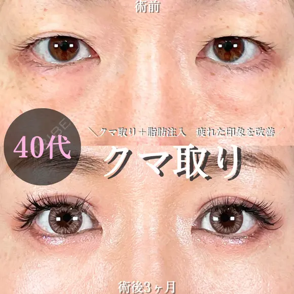 目の下のクマ取り/脂肪注入(目の下・ゴルゴライン) 90日後 メイン用
