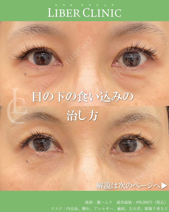 目の下の食い込みの治し方 before画像 メイン用