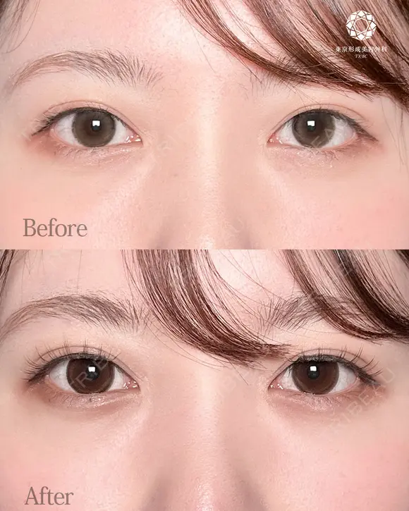 涙袋ヒアルロン酸 before画像 メイン用