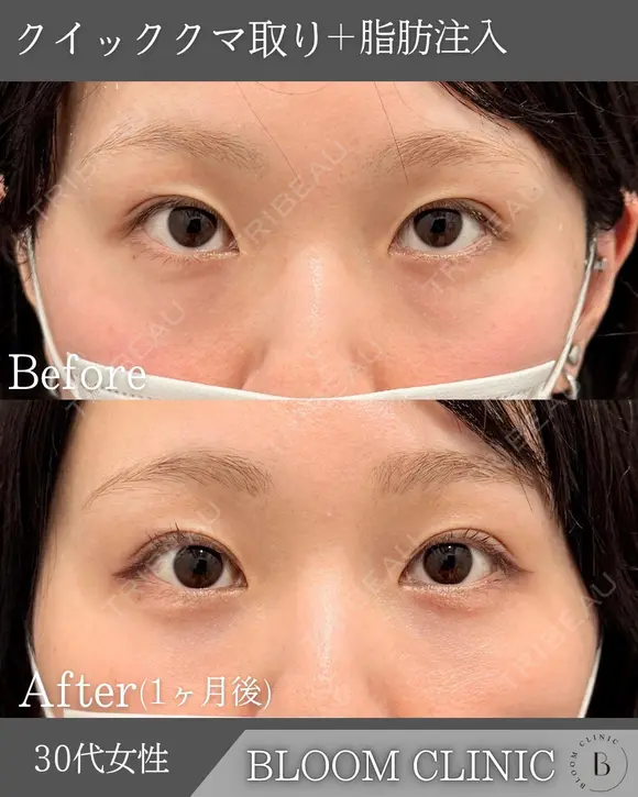 フラットな目元に😌☘️クマ取り、脂肪注入 after画像 メイン用