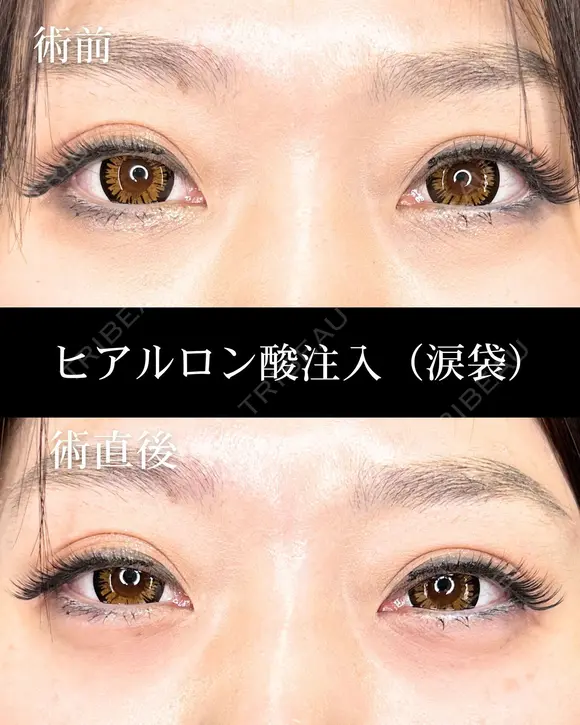 ヒアルロン酸注入（涙袋） after画像 メイン用