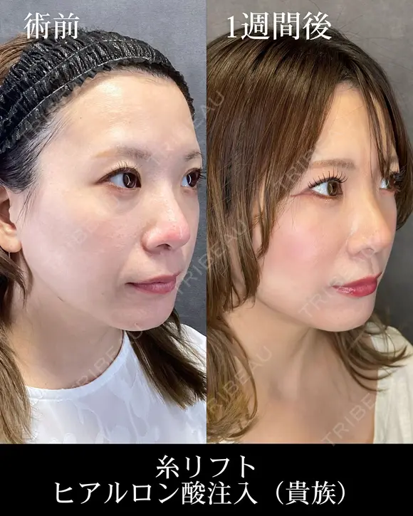 糸リフト/ヒアルロン酸注入（貴族） 7日後 メイン用
