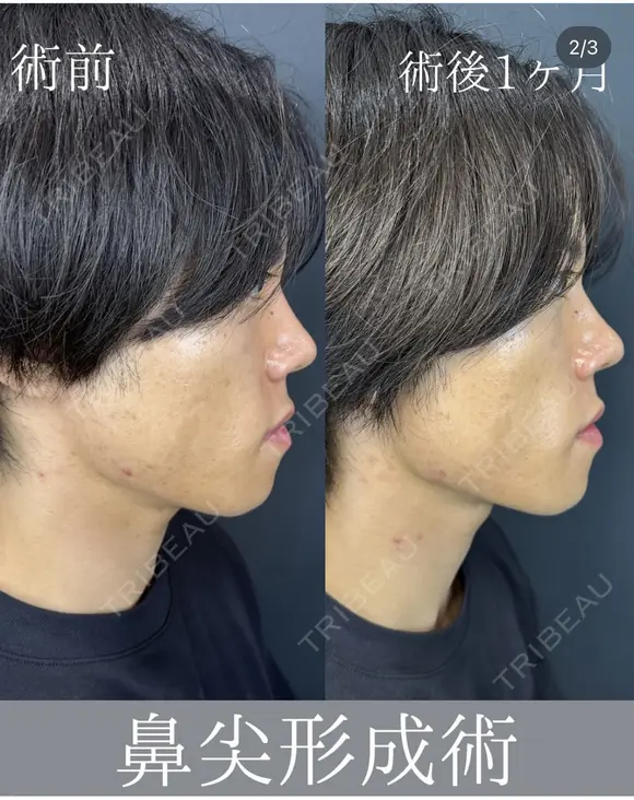 鼻尖形成術クローズ法 before画像 メイン用