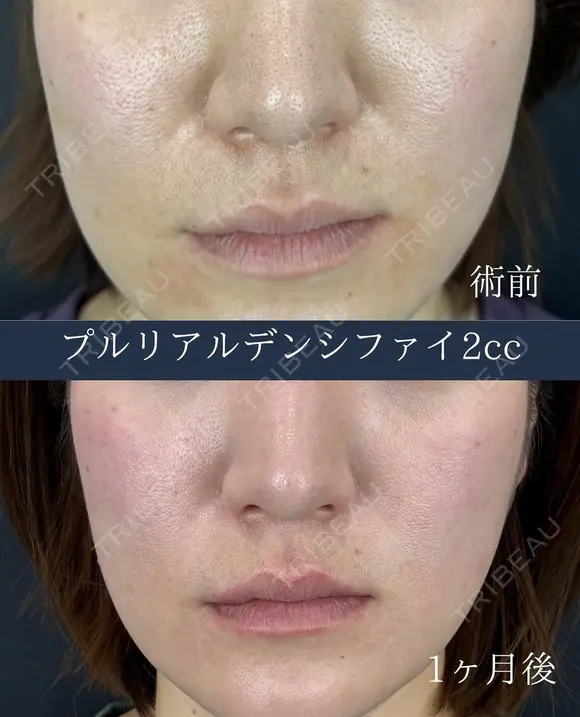プルリアルデンシファイ2cc before画像 メイン用