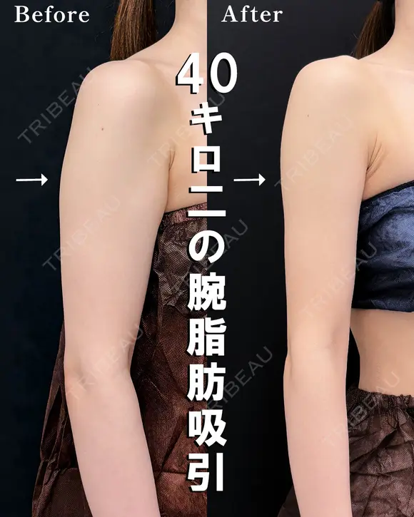 ベイザー併用アキーセル二の腕脂肪吸引 before画像 メイン用
