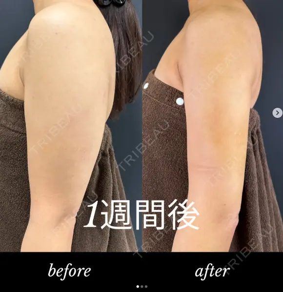 二の腕脂肪吸引 before画像 メイン用