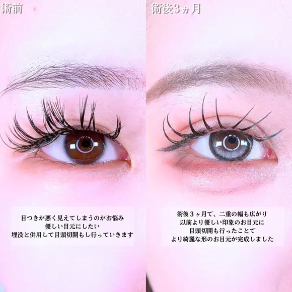 アリエルクイックループトリプル二重埋没法/目頭切開 before画像 メイン用
