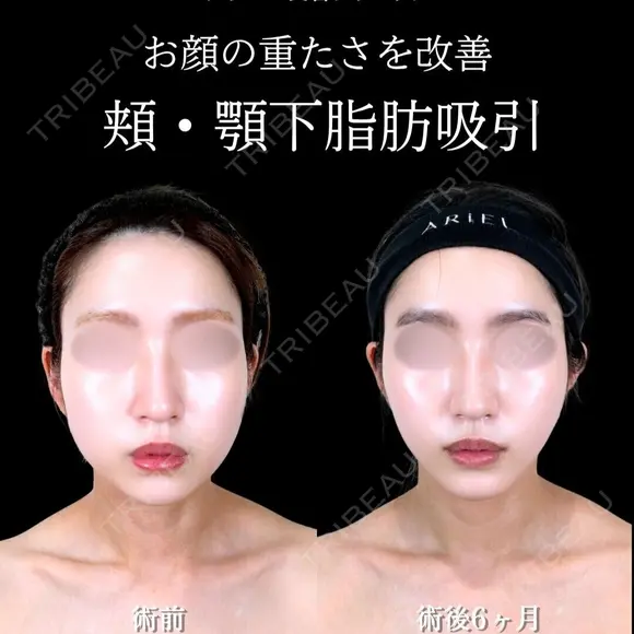 頬・顎下脂肪吸引/ジョールファット/糸リフト  180日後 メイン用