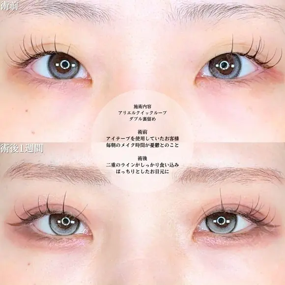 アリエルクイックループダブル二重埋没法 before画像 メイン用