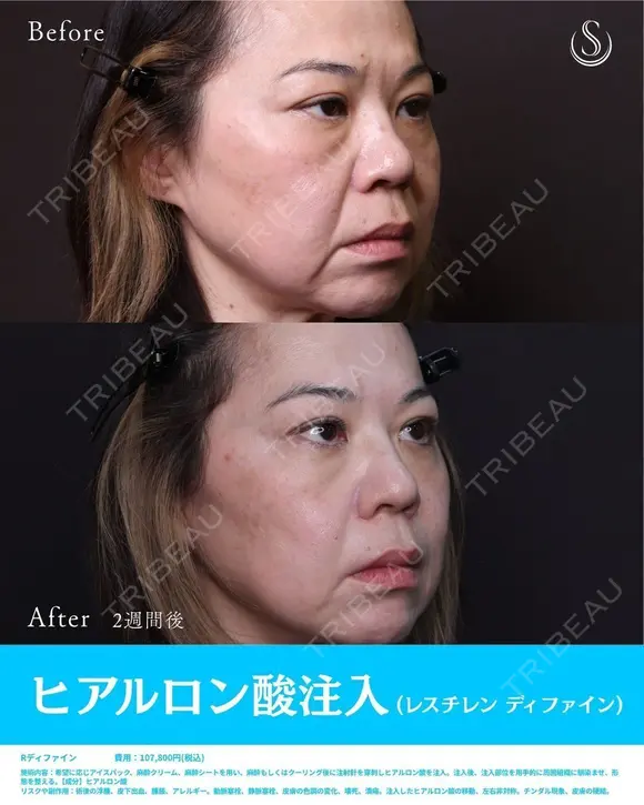 ヒアルロン酸注入　レスチレンデファイン　(ほうれい線・マリオネットライン) before画像 メイン用